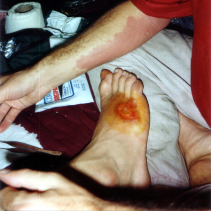 Le pied de l'Australien que j'ai tenté de soigner. Il a été contraint de rentrer en Australie pour sauver son pied.